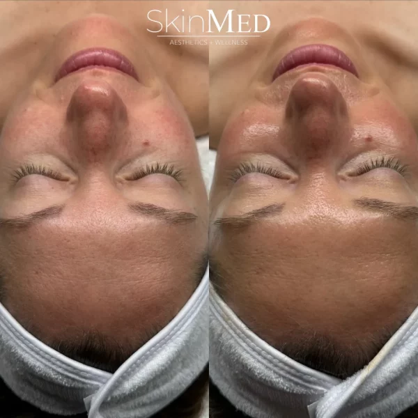 Skinmedhealth-BA-Hydrafacial-Brooke-a-in-Chattanooga-TN