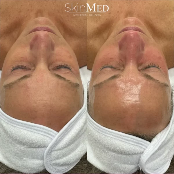 Skinmedhealth-BA-Hydrafacial-a-in-Chattanooga-TN