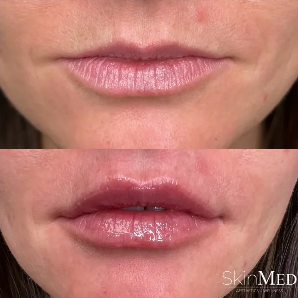 Skinmedhealth-BA-Lip-Filler-Ashley-lips-a-in-Chattanooga-TN