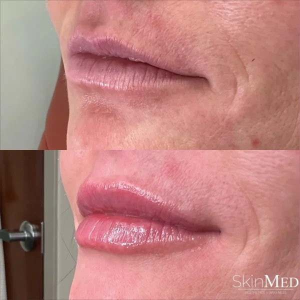 Skinmedhealth-BA-Lip-Filler-Ashley-lips-b-in-Chattanooga-TN