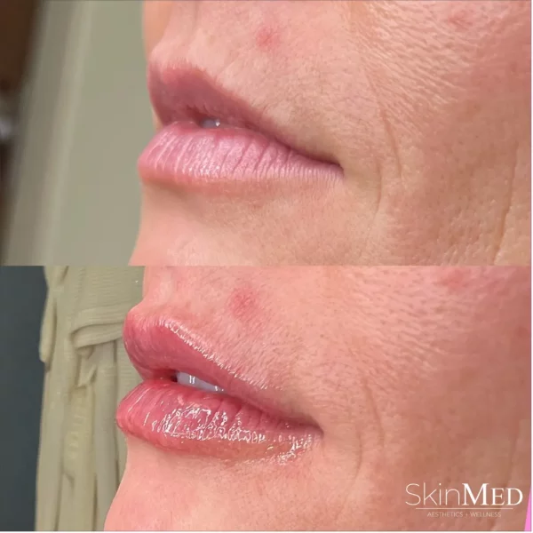 Skinmedhealth-BA-Lip-Filler-Ashley-lips-c-in-Chattanooga-TN