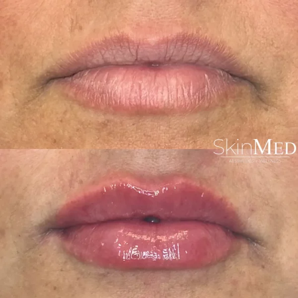 Skinmedhealth-BA-Lip-Filler-DeAnn-a-in-Chattanooga-TN