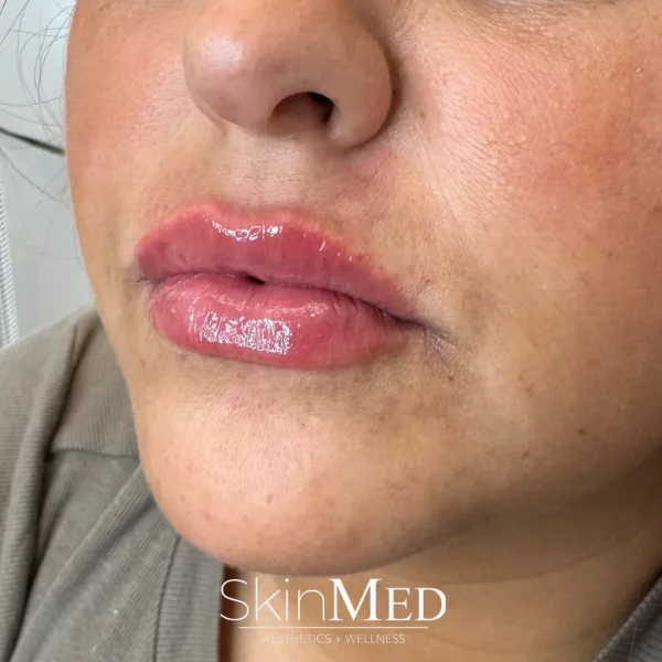 Skinmedhealth-BA-Lip-Filler-DeAnn-b-in-Chattanooga-TN