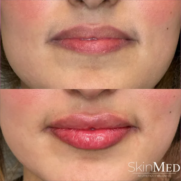 Skinmedhealth-BA-Lip-Filler-Rania-lips-a-in-Chattanooga-TN