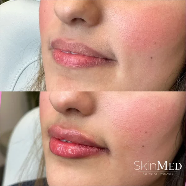 Skinmedhealth-BA-Lip-Filler-Rania-lips-b-in-Chattanooga-TN