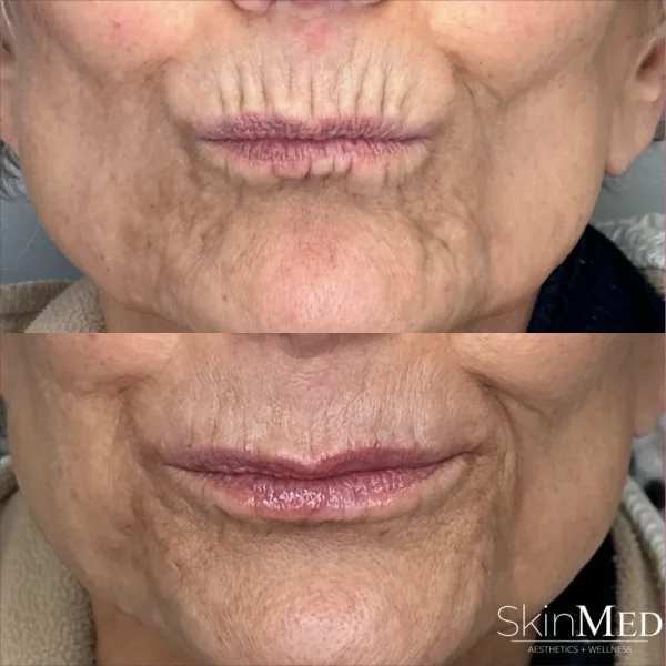 Skinmedhealth-BA-Lips-Perioral-Joni-a-in-Chattanooga-TN