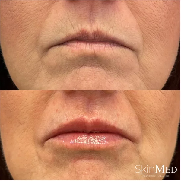 Skinmedhealth-BA-Lips-Perioral-Tambi-a-in-Chattanooga-TN