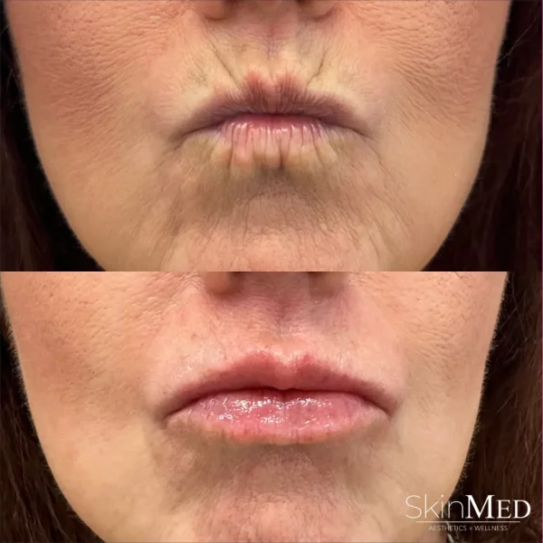 Skinmedhealth-BA-Lips-Perioral-Tambi-b-in-Chattanooga-TN