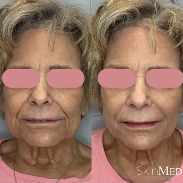 Skinmedhealth-BA-Lower-Face-joni-a-in-Chattanooga-TN