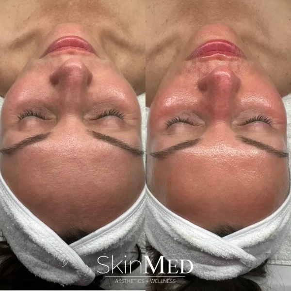 Skinmedhealth-BA-hydrafacial-Gayle-a-in-Chattanooga-TN