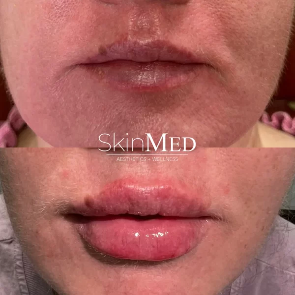 skinmedhealth-BA-lip-filler-amy-a-in-Chattanooga-TN