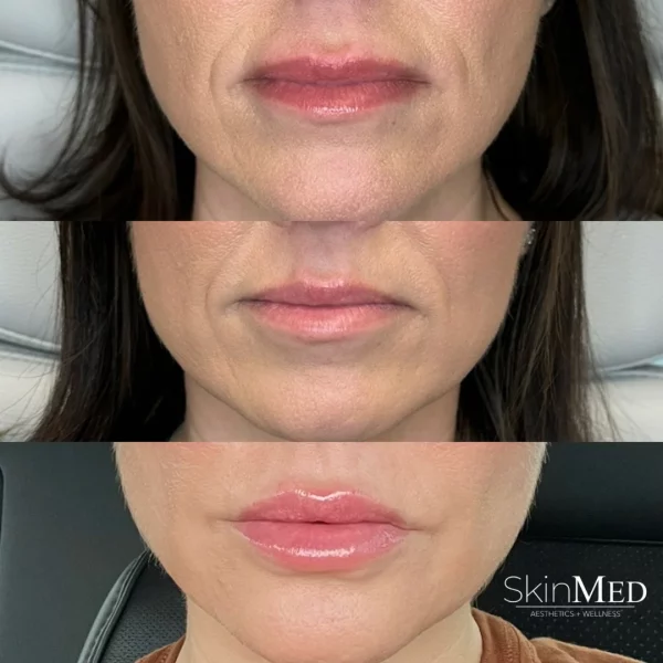 skinmedhealth-BA-lip-filler-gayle-a-in-Chattanooga-TN