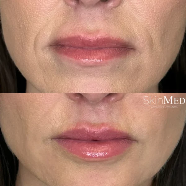 skinmedhealth-BA-lip-filler-gayle-b-in-Chattanooga-TN